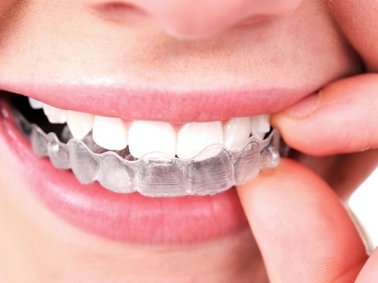 How to Clean Invisalign Aligner – Rules to Follow